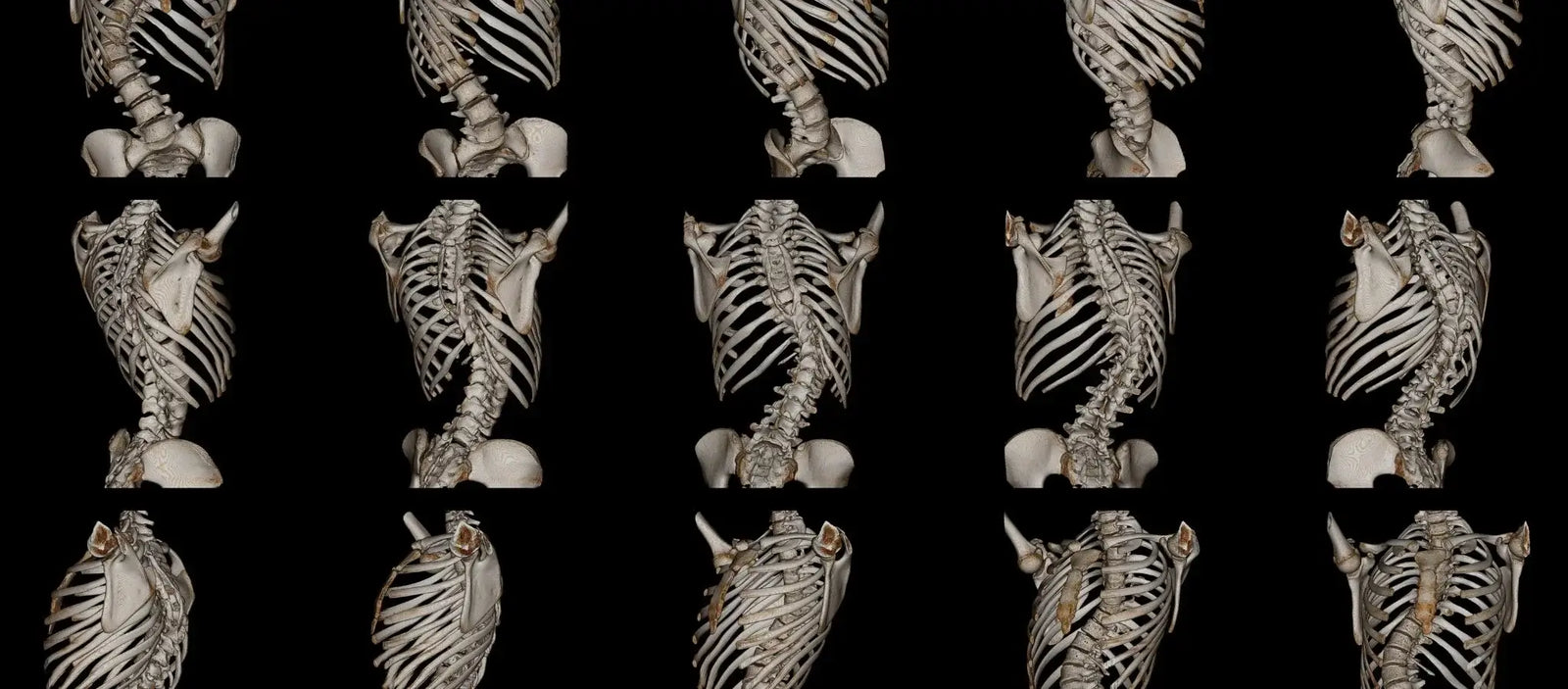 Image for the 'Natural Scoliosis Pain Relief: Tips & Solutions' post by MDBiowellness- Plant Medicine. A person considering surgery as an option for scoliosis pain relief. Developed by Doctors.